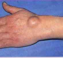 Vzroki za nastanek grudice ali higrome na roki
