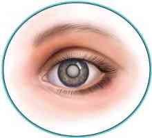 Vzroki za nastanek tančice v očesu in nejasen vid