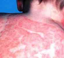 Vzroki, simptomi in zdravljenje atopičnega dermatitisa