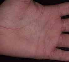Vzroki za srbenje dlani - zakaj so moje roke srbeče?