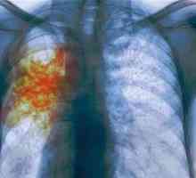 Znaki tuberkuloze v zgodnjih fazah odraslega
