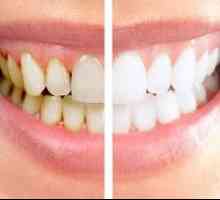 Profesionalno zobno čiščenje v zobozdravstvu: tipi in opis