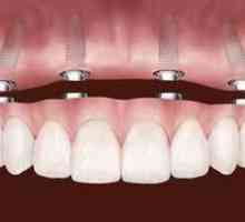 Protetika zob na implantatih: odstranljiva proteza