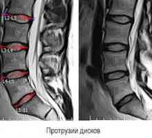 Izpiranje hrbtenice ledvene hrbtenice: znaki in simptomi