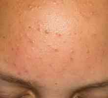 Akne na čelu žensk: zdravljenje in vzroki