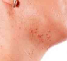 Akne na vratu pri ženskah: vzroki za izpuščaje