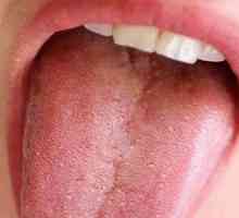 Pimples na jeziku so bližje grla: rdeči mozolji