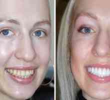Obnova zob: glavne vrste in koliko bo stalo