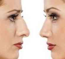 Rinoplastika: značilnosti plastične kirurgije na nosu