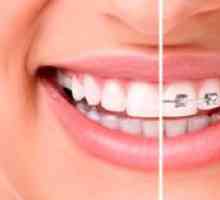 Self-ligating braces: lastnosti in prednosti