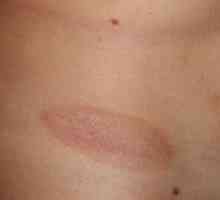 Luskav rdeče madež na telesu: pogoste bolezni