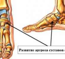Simptomi noge artroze in sklepov na nogi s fotografijami