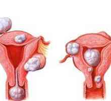 Simptomi fibroidne fibroze in metode zdravljenja tumorja