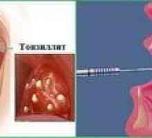 Simptomi kroničnega tonzilitisa pri otrocih - njeno zdravljenje in preprečevanje