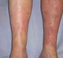 Simptomi in zdravljenje dermatitisa na nogah, foto