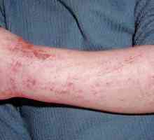 Simptomi in zdravljenje dermatitisa pri odraslih, foto