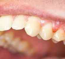 Simptomi in zdravljenje kroničnega periodontitisa