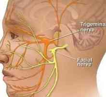 Simptomi in zdravljenje vnetja trigeminalnega živca