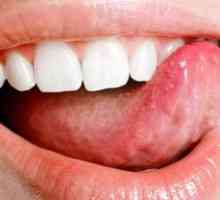 Simptomi in znaki raka jezika