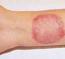 Simptomi miokoza kože in zdravljenje te bolezni