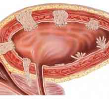 Simptomi tumorja mehurja pri ženskah in moških