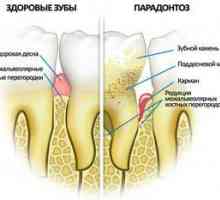Simptomi parodontalne bolezni in kako se zdravijo doma