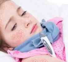 Škrlatna vročina pri otrocih: simptomi in zdravljenje, foto