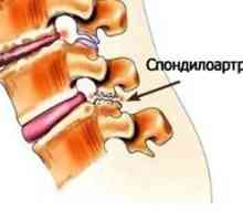 Spondiloza lumbosakralne hrbtenice: zdravljenje