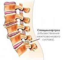 Spondilartroza ledvene hrbtenice