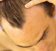 Metode zdravljenja androgene alopecije pri moških in ženskah