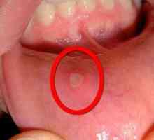 Stafilokoki v ustih: simptomi, načini zdravljenja, fotografija