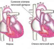 Stenoza pljučne arterije pri novorojenčkih