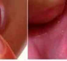 Stomatitis ustnic: na notranji strani