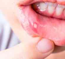 Stomatitis pri otrocih: kako zdraviti to bolezen?