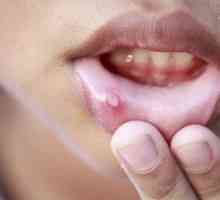 Stomatitis v ustih: zaradi tega, kar se zgodi in kako zdraviti