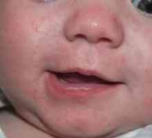 Izpuščaji okoli ust otroka: razlogi za videz