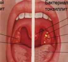 Tonsilitis: znaki, simptomi, zdravljenje
