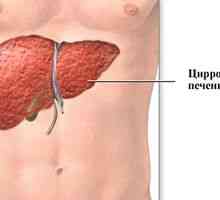 Moteči simptomi ciroze jeter pri ženskah