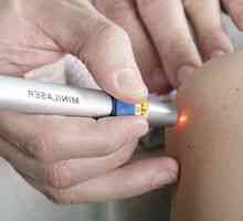 Lasersko odstranjevanje papiloma: koristi, učinki in povratne informacije