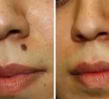 Odstranjevanje molov na obrazu: osnovne metode in fotografije