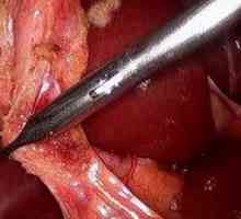 Odstranjevanje žolčnika: video operacije laparoskopija