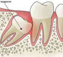 Modrost zob ekstrakcija na zgornji čeljusti