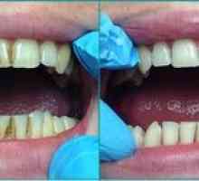 Ultrazvočno čiščenje zob za odstranjevanje plošče in kamna