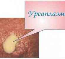 Ureaplazmoza pri moških in ženskah: zdravljenje in simptomi