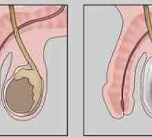 Dropsy testicles: kakšna grožnja je pojav tekočine v mošnjici