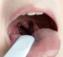 Vnetje tonzil v grlu: vzroki, simptomi in zdravljenje