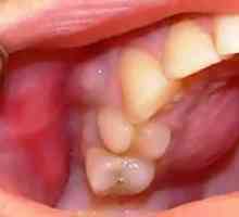 Vnetje periosteuma zoba: zdravljenje, simptomi periostitisa