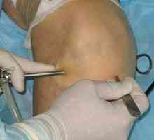 Obnova po operaciji artroskopije kolenskega sklepa: pregledi