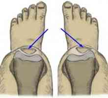 Vročinska patologija kolenskega sklepa - displazija