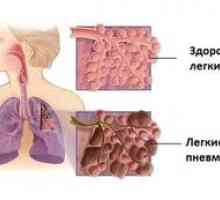 Vse o pljučni fibrozi: kako zdraviti fibrozne spremembe v pljučih